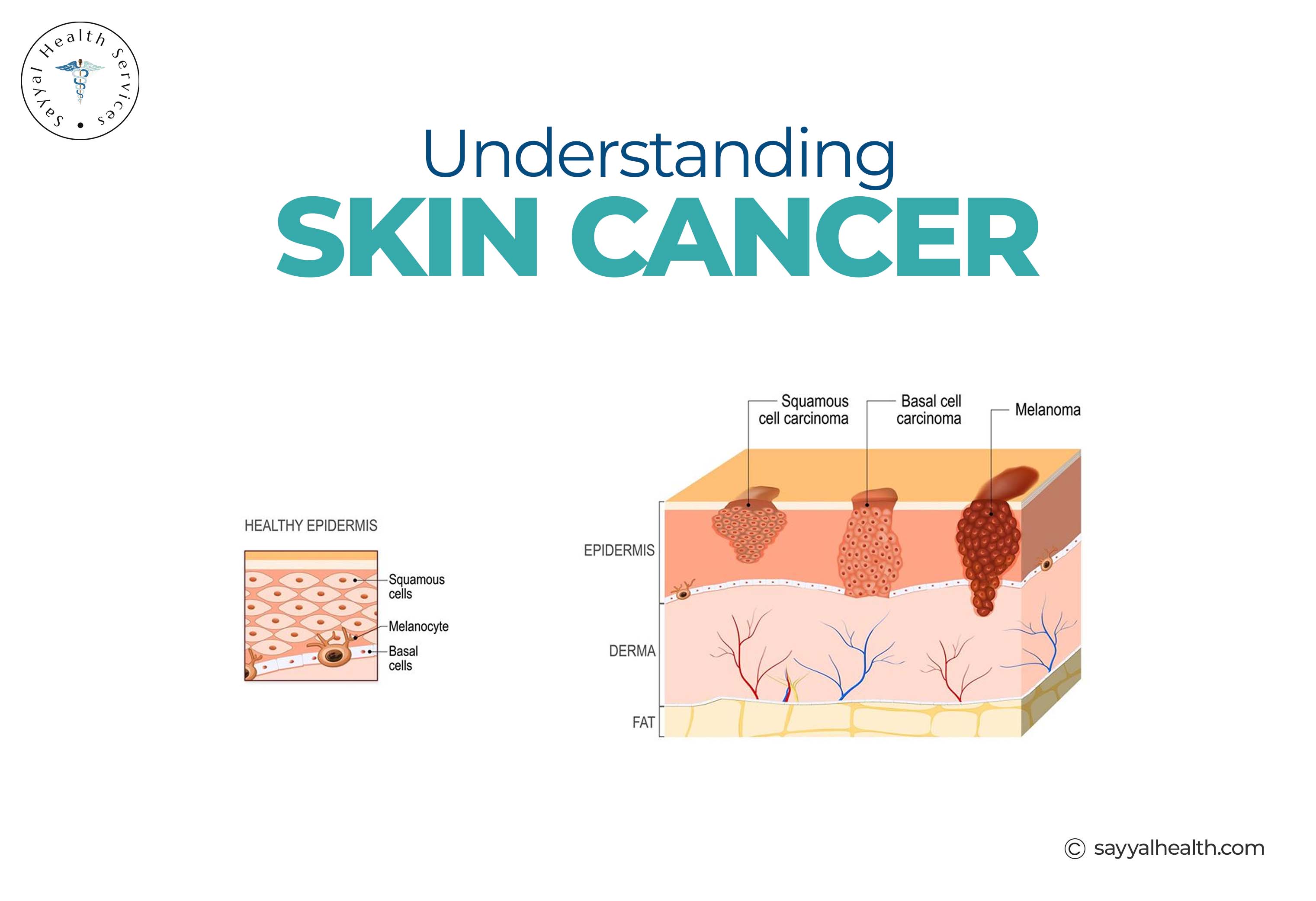 understanding skin cancer